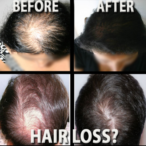 Stop Hair Loss with Laser treatment Comb-pur-wish